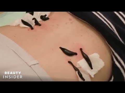 Holistic Center Performs Leech Therapy