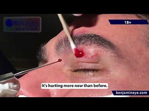 Epidermal Inclusion Cyst Removal