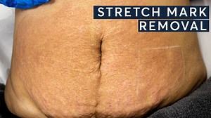 Stretch marks are common for many men and women. They occur when the...