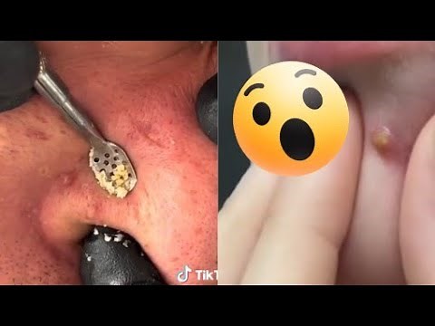 Ultimate Pimple Popping Compilation 2024 | Satisfying Blackhead & Acne Removal | Oddly Satisfying