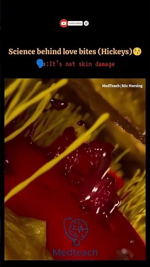 How Love Bites Cause Redness | Hickey Explained Medically #youtubeshorts #medicalshorts