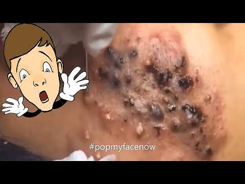 BEST INFECTED ACNE BLACKHEAD REMOVAL PART 3 🤓 🤯 EXPLOSION💯💥 #popmyfacenow #bestacneinfection