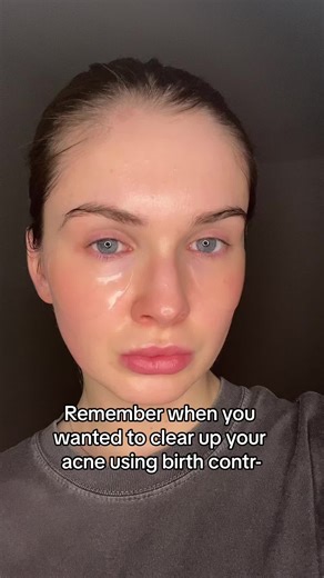 Birth Control Pills for Acne Management: Pros and Cons