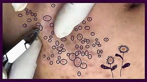 Blackhead Squeeze, Popping, Pimples Removal - 2018 👉 WATCH OTHER VIDEOS: 1. Worlds biggest blackhead @ https://fb.com/553664515159423 2. Pimple blackhead Big Whiteheads & Blackheads On Cheek | Removal Simple & Easy @ https://fb.com/2282619241992207 3. 𝐁lackhead 𝐑emoval 2019 𝐁lackheads 𝐀nd 𝐖hiteheads @ https://fb.com/354648021840258 4. Wonderful Blackhead Removal Pimple blackhead Suri Job 83: How to Get Rid of Infected Acne on Young @ https://fb.com/2298056747143851 5. Why do we love Poppin