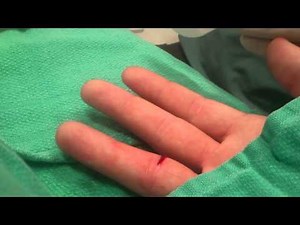 How to get stitches on your finger