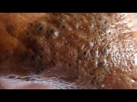 Blackheads, Blackhead and Open Comedones! Blackhead Fields