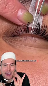 VIRAL INGROWN EYELASH REMOVAL!😱 Credit: @BBL Danielle #ingrownhair #ingrownhairremoval #pimplepop #pimplepopper