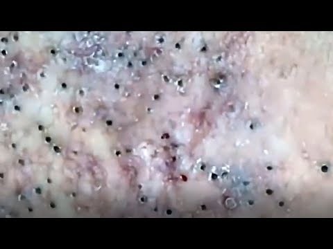 Blackheads removal from face - blackhead removal - acne 2019