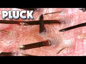 Dr. Popper's Plucking Hair! Up Close! Popping Pimples, Skin, Microscope