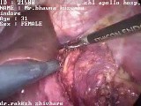 Laparoscopic left adrenalectomy • Video • MEDtube.net