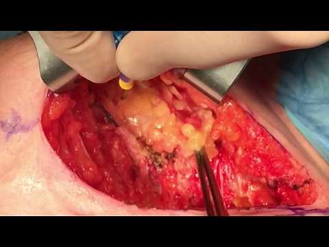 Inguinal lymphadenectomy for vulvar cancer. Dr. Lucas Minig, Gynecologic Oncology; Valencia Spain.