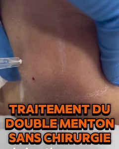 ❣️Traitement du double menton sans chirurgie❣️ 💫✨DERMOJEUNESS Lac2 ✨💫 📱Pour plus d’informations veuillez appeler ☎️ 56791911 #dermojeuness #pb #pbserum #pbserummedical #menton #doublementon #injection #injections #lipolyse #femme #homme #beauty #beauté #beaute #tunis #tunisie #Tunis #Hammamet #ariana #bizerte #traitement #traitementdoublementon #sans #sanschirurgie | Dermojeuness