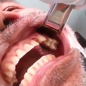 9.6K views · 51 reactions | alveolar bone fracture! | Medical Students | Facebook