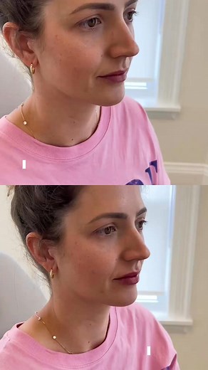 Before ➡️ After 💋 Volume. Definition. Balance. Hydration. We're obsessed—and here’s why: - More volume (without overdoing it) - Symmetry that flatters the whole face - Defined Cupid’s bow = instant glow-up - Smoother lips, fewer lines We’re all about enhancing your natural lips, so you still feel YOU. Book a consult with us using the link in our bio. #LipFiller #BeforeAndAfter #AndersonMedicalAesthetics #NaturalResults #KingsvilleAesthetics #SubtleEnhancement #FacialBalancing | Anderson Medical
