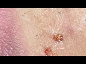 Acne Treatment Nhat Bang #11