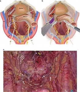 Laparoscopic total pelvic exenteration: a simplified procedure using the fascial space priority approach