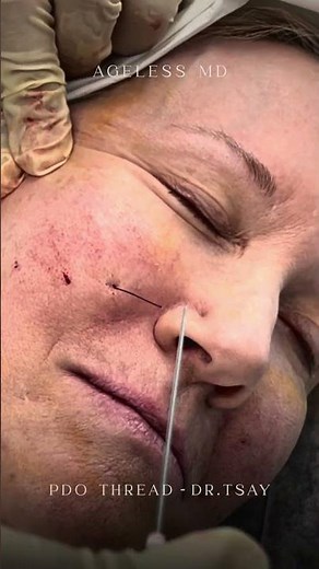 MINT PDO Threads(Nonsurgical Facelift) by Dr. Tsay