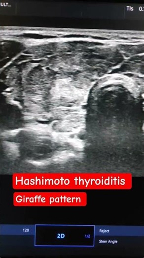 Hashimoto thyroiditis: diffusely bulky thyroid with hyperechoic nodules and echogenic fibrous septa