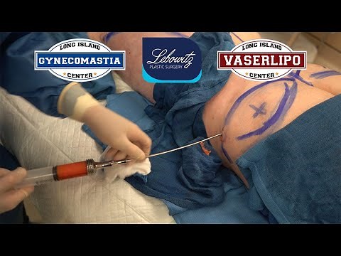MALE Vaser 4D Dynamic Hi-Def LipoSculpture with GLUTEAL LIPOFILLING - Dr. Lebowitz