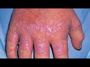 How To Treat And Cure Lichen Planus