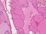 Colloid goiter - Histopathology of thyroid • Video • MEDtube.net