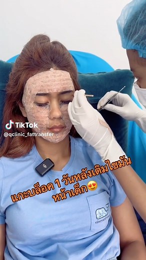 ใครๆก็อยากหน้าเด็ก✅😍#หมอโบนัสคิวคลินิก #เติมไขมัน #เติมไขมันหน้าเด็ก #รีวิวเติมไขมันหน้าเด็ก #qclinic #Qclinic #ทีมหมอจั๊ม | เติมไขมันหน้าเด็ก by Q Clinic คิวคลินิก