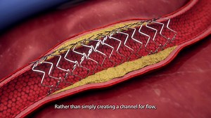 DynamX not only restores blood flow in coronary arteries but also...
