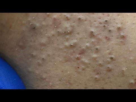 Deep Cleansing Techniques For Acne — Satisfying Blackhead Extraction