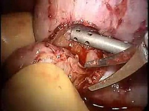 Laparoscopic Hand-Assisted Partial Nephrectomy