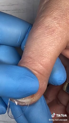 Brachydactyly thumb #nails #nail #apresgelx #growth #glow #nailtutorials #fakenails #longnails #trending #diy #nailtech #omaha #fyp #Brachydactyly