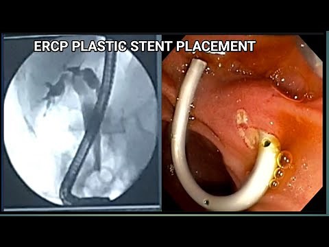 ERCP Plastic stent Placement #BD_ENDOSCOPY