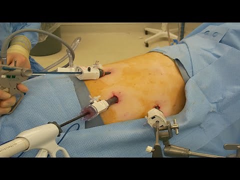 ADRENAL GLAND REMOVAL | ADRENALECTOMY PATIENT INFORMATION FROM SAGES