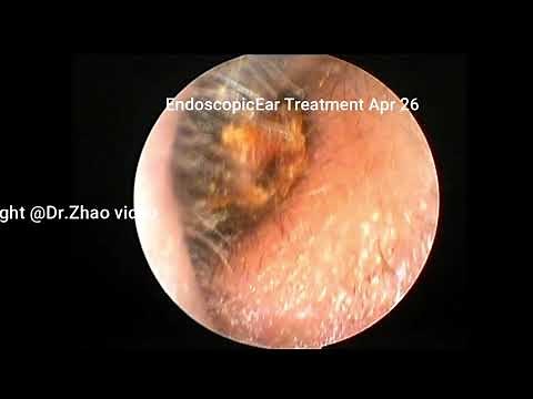 Ear Wax Removal extration Special middle ear cholesteatoma and external auditory canal cholesteatoma