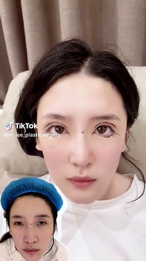 eyelid surgery, lens enlargement #drlee #eyelid #cosmeticsurgery