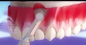 Apiceoctomy Procedure #dentist #dentistry #dentista #smile #surgery | About Dentistry