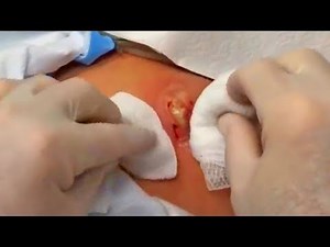 10-Year-Old Cyst Revisited from Dr. Gilmore Fan Page