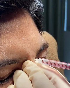 4.1K views · 100 reactions | Procedure: BOTOX upper face Reduce wrinkles and fine lines Make your skin tight #allergan #botox #drtasnimkhan | Dr Tasnim Khan | Facebook