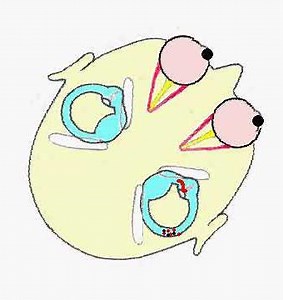 Right Horizontal Canalithiasis Pathophysiology