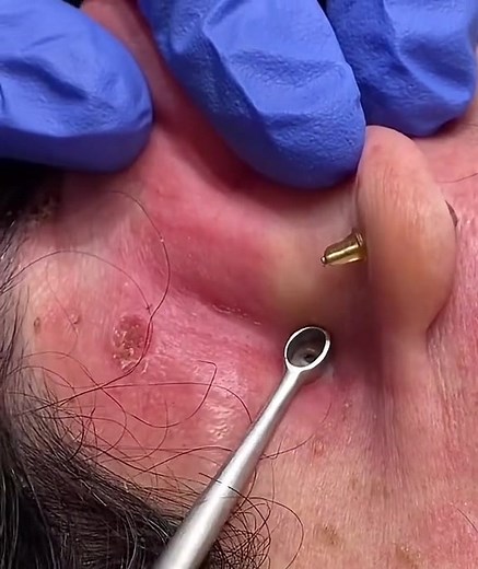 pimples on faces #cravos #blackhead #zit #popper #acne