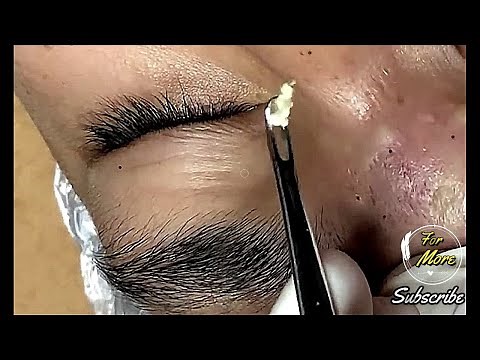 Dr Pop - Quick blackhead & whitehead removal 2020 || Satisfying HD