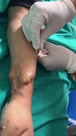 AVF Cannulation for Dialysis: A Healthcare Procedure