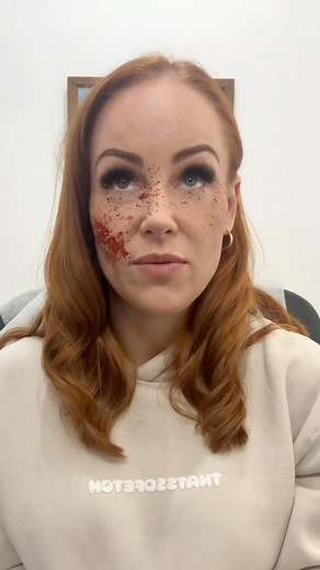 We know when you lie 🤣 Aspirin is a blood thinner, which can increase the risk of bruising, swelling, and bleeding at the injection site. #bridesmaids #brisbanecosmeticnurse #cosmeticinjector #brisbaneinjectables #northbrisbaneinjectables #snatched #reducewrinkles #cosmetics #humor | E.W. Cosmetic Injector & Laser Clinics