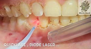 Laser Gingivectomy After Ortho treatment ( CCL ) Episode 2 of 2 Please Watch in HD , and check Episode 1 of 2 | Dr Samer Al Mabrouk Oral Surgeon & Implantologist