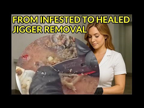 Jigger Treatment Transformation Journey