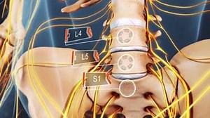 93K views · 2.1K shares | The vast majority of sciatica symptoms...