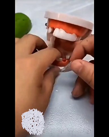 Temporary Tooth Repair Kit, Temporary Filling Teeth Glue for Filling Fix The Missing and Broken Tooth(30g)