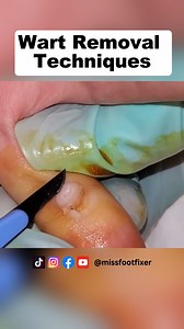 3.3K views · 12 reactions | Wart Removal Techniques: How To Use Silver Nitrate & Immune Response To Fight HPV | Miss Foot Fixer #footwart #footwartremoval #missfootfixer | Miss Foot Fixer | Facebook