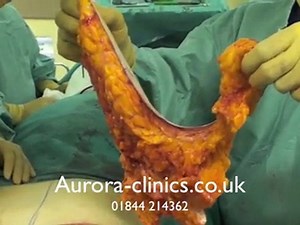 How to perform a breast reduction