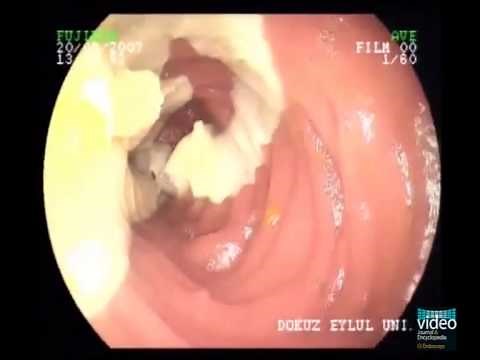 Taenia saginata in the Small Intestine