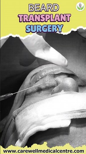 Beard Transplant Full Process! 🧔🏻✨ From Marking to Grafting | Care Well Medical Centre